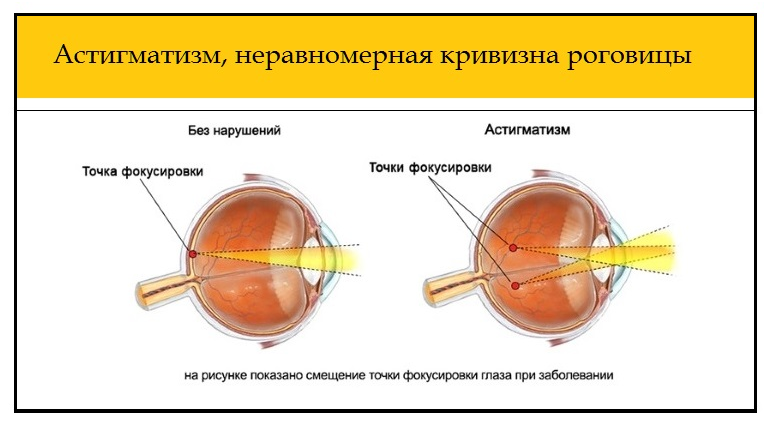 причины психосоматики астигматизма