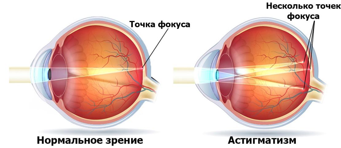 сложный миопический астигматизм у детей