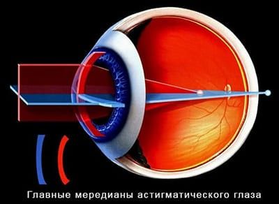 Врожденный астигматизм у взрослых