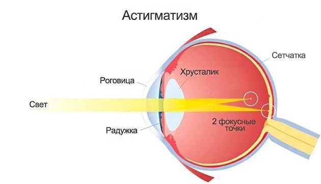 исправить астигматизм без операции