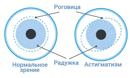 Передается ли астигматизм по наследству