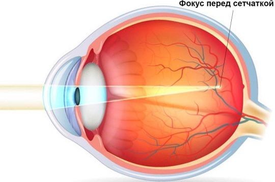 школьная близорукость