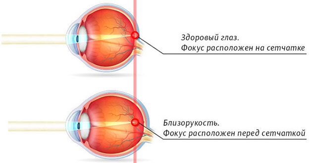 глаз при близорукости